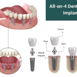 all-on-4-dental implants