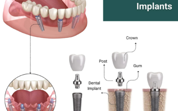 all-on-4-dental implants