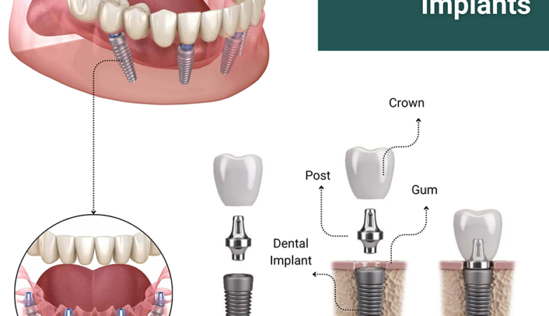 all-on-4-dental implants