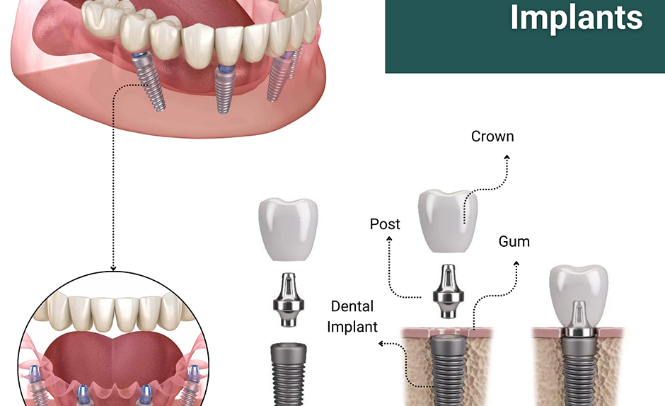 all-on-4-dental implants