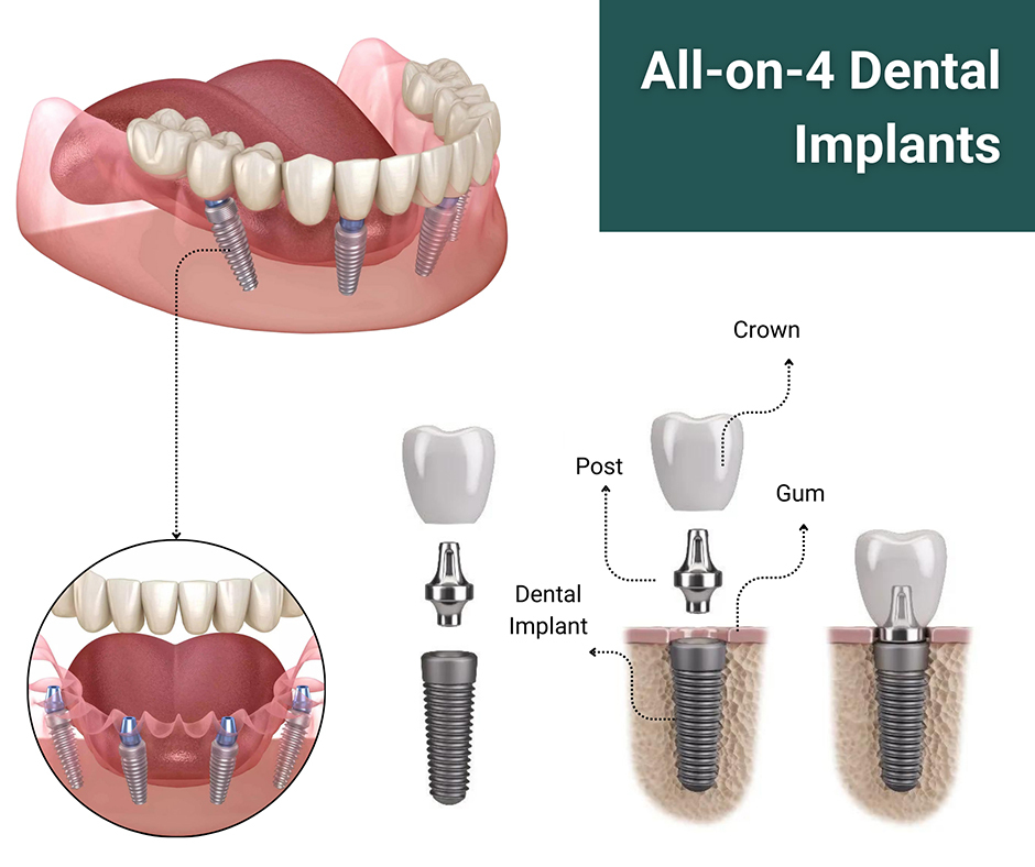 The Most Common Questions My Patients Ask About All-on-4 Dental Implants