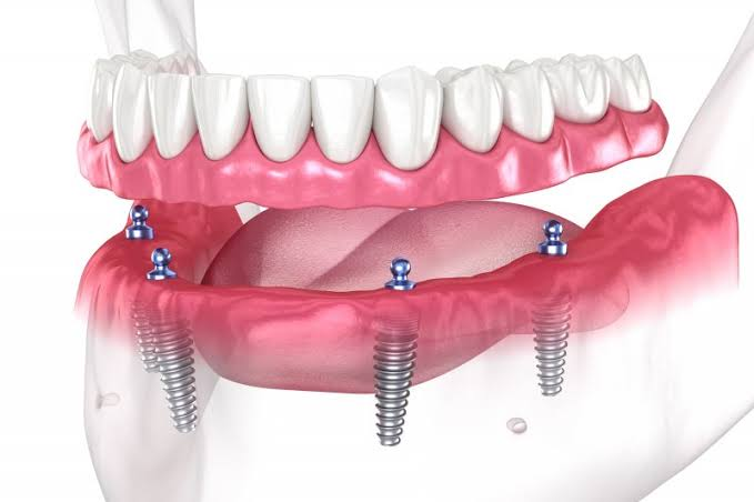 All on 4 dental implants
