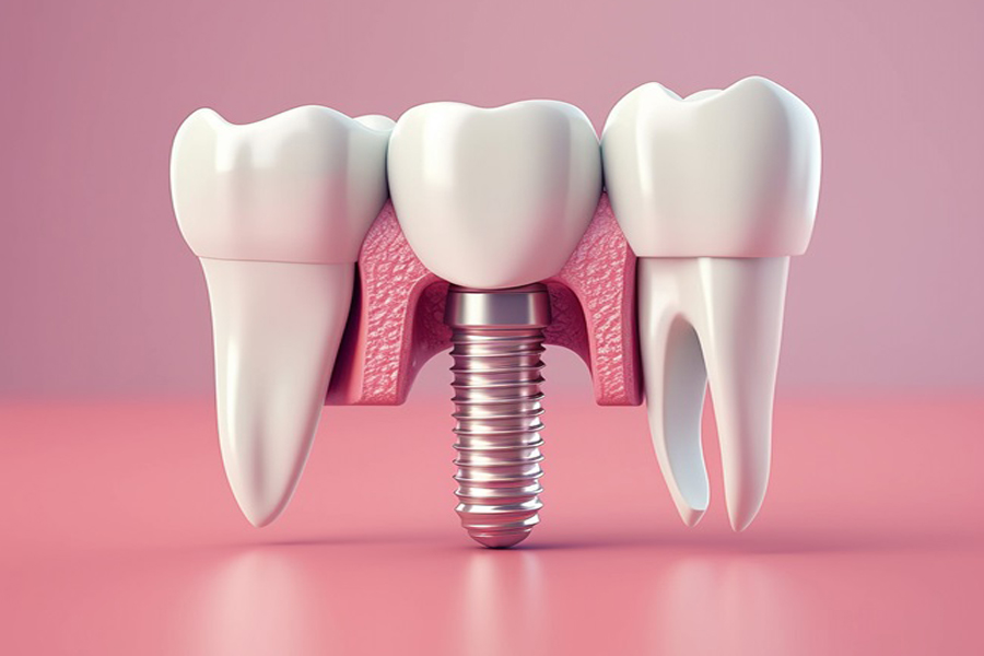 Implant dentist Century City
