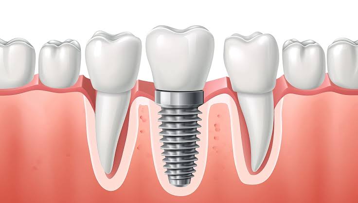 Dental implants Century City